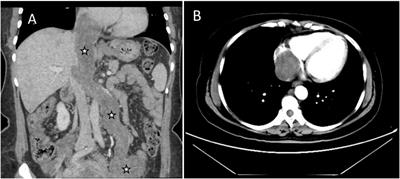 Imaging findings of Budd-Chiari syndrome caused by intravenous leiomyomatosis: a case report